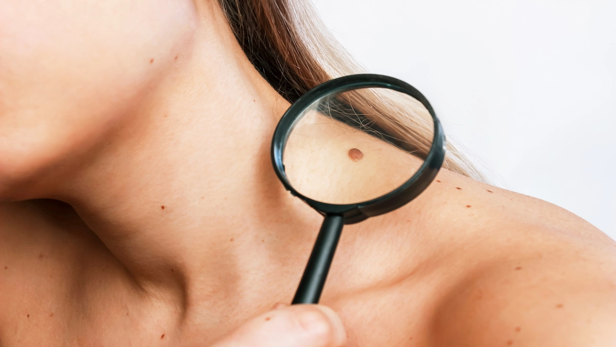 SKIN CANCER PREVENTION & TREATMENT MELANOMA SKIN SPECIALIST